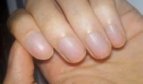 「月牙」越多，身體越好？許多人都理解錯了，看看自己屬於哪種