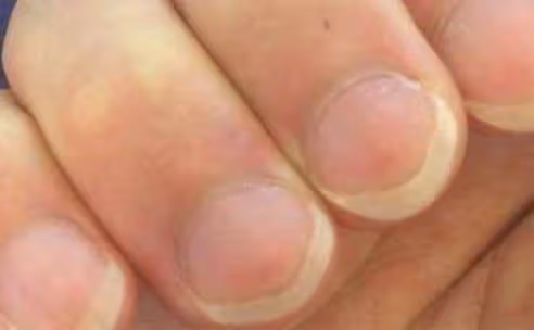 「月牙」越多,身體越好?許多人都理解錯了,看看自己屬於哪種