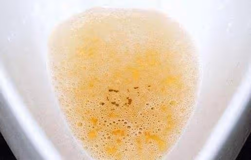 排尿時發現尿液太黃、味道還大?或是身體在提醒你要注意幾件事了