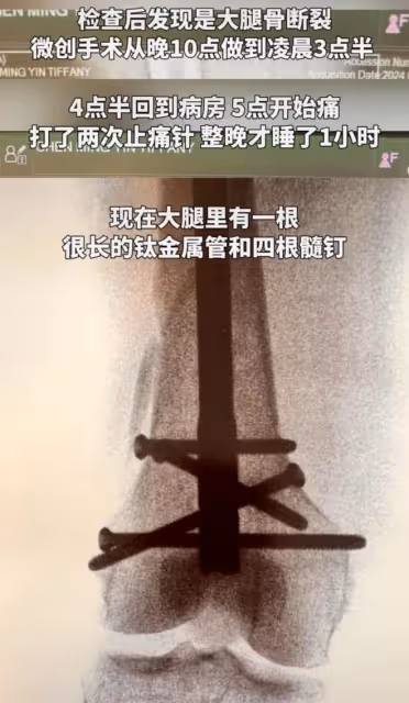 突發！向太陳嵐不幸摔倒入院急救！救治畫面曝光，做手術打鋼管