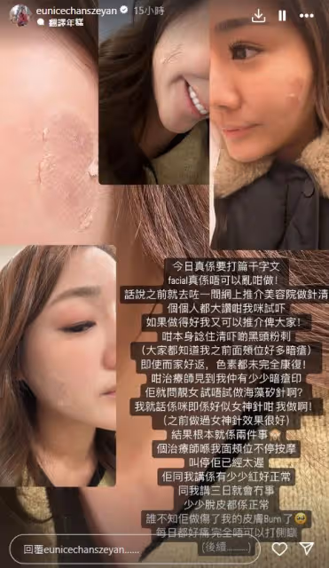 TVB離巢小花慘遭毀容，美容院護膚反變爛臉，發現時叫停已太遲
