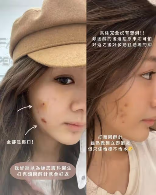 TVB離巢小花慘遭毀容，美容院護膚反變爛臉，發現時叫停已太遲
