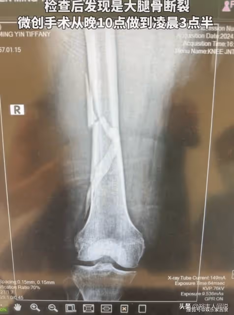 突發!向太豪宅中不慎滑倒,大腿骨裂手術5小時,向華強全程陪伴