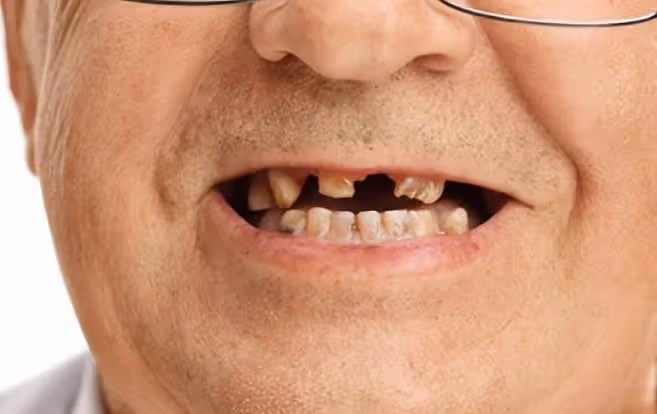掉牙和壽命有關?55歲的人,牙齒剩多少算正常?看看你達標嗎?