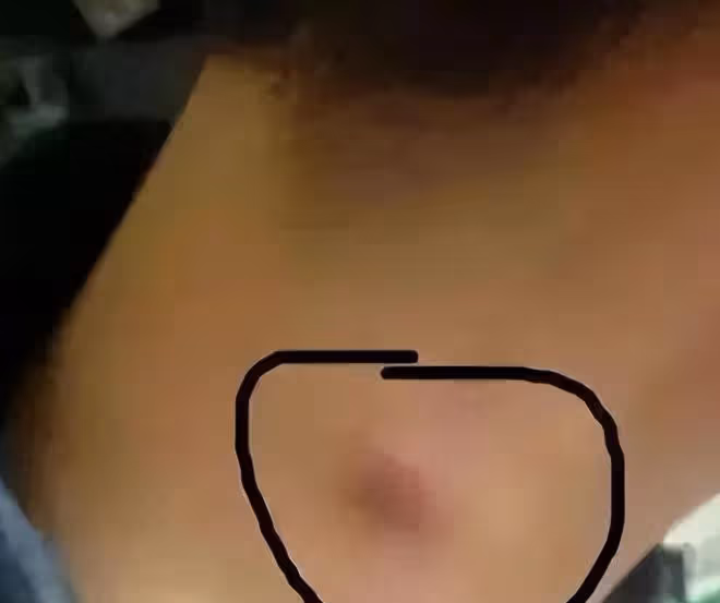 體內有癌,脖子先知?提醒:脖子出現2個異常,小心是癌症找上門