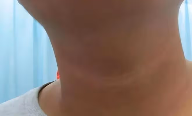 體內有癌,脖子先知?提醒:脖子出現2個異常,小心是癌症找上門