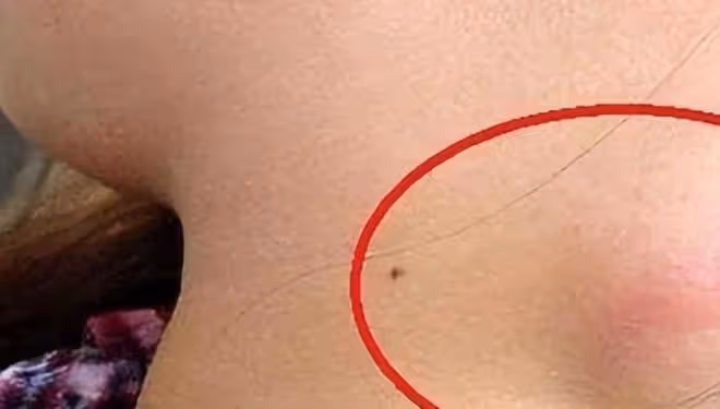 體內有癌,脖子先知?提醒:脖子出現2個異常,小心是癌症找上門