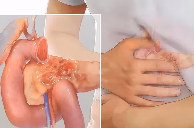每天兩三次「大號」,48歲男子竟查出胰腺癌!這5大信號不能忽視
