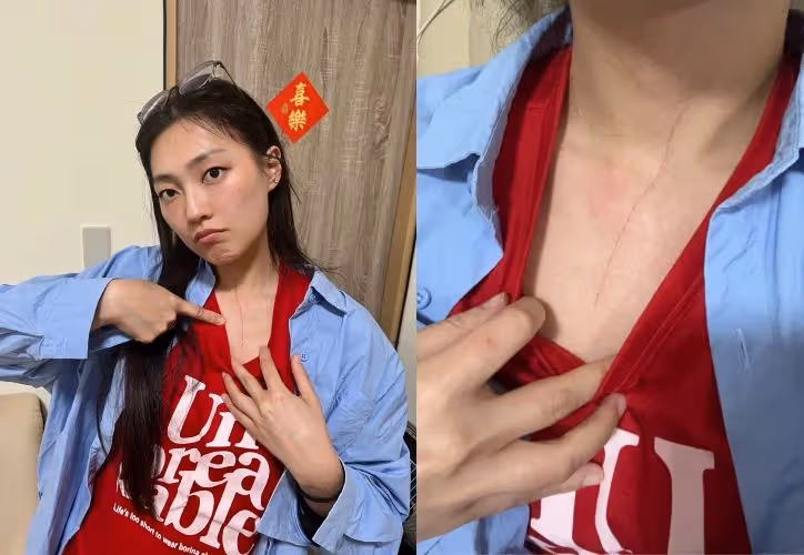 家裡養老虎嗎？ A-Lin愛徒遭「家暴」胸口抓出10公分血痕