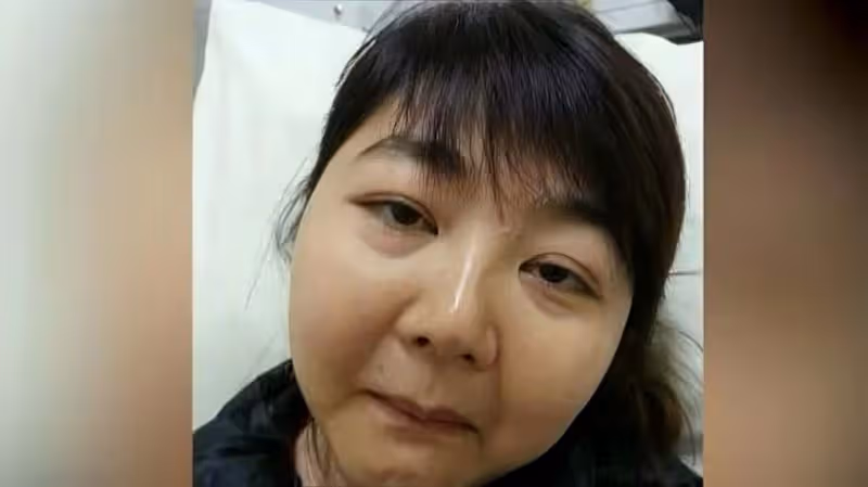 香港女星患末期腎衰竭,每周洗血三次,因吃激素藥容貌大變