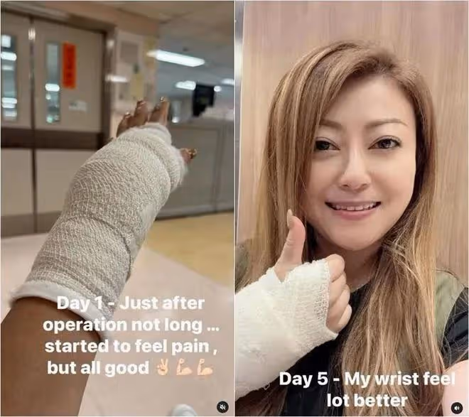 TVB中年女歌手患腱鞘囊腫,開刀切除左手水囊,術後用力唱歌感麻痺