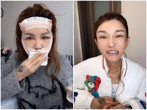 砸590萬整形失敗! 陸網紅一笑「臉歪嘴斜」後悔:沒回頭路可走