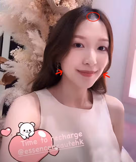 港姐郭嘉文近照顯壯碩,髮際線稀疏嘴型怪異!被質疑已懷孕生子