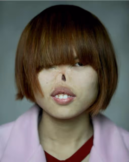 1996年,出生29天的女嬰被老鼠咬掉鼻子,與網戀帥小伙閃婚