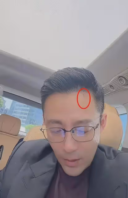 汪小菲額頭有抓痕,婚後直播馬筱梅未跟隨,馬筱梅長相太像S媽!