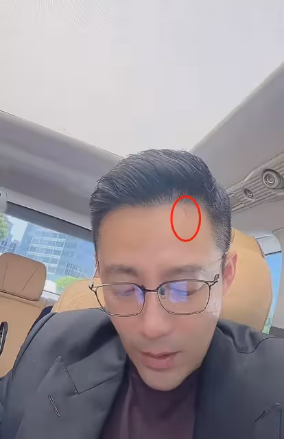 汪小菲額頭有抓痕，婚後直播馬筱梅未現身，馬筱梅長相撞臉S媽！