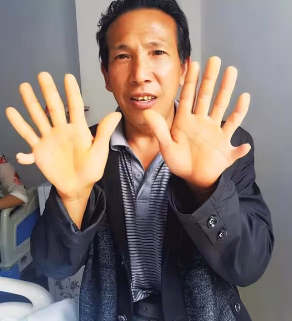 回顧:28歲男子力大無窮,檢查出有4個腎,妻子回應:他身體很好