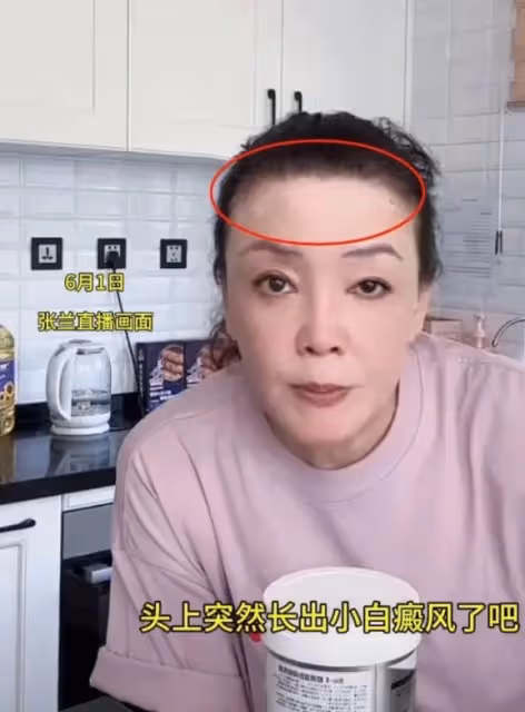 張蘭自曝患白癜風,心態樂觀引關注,病情中展現女強人本色