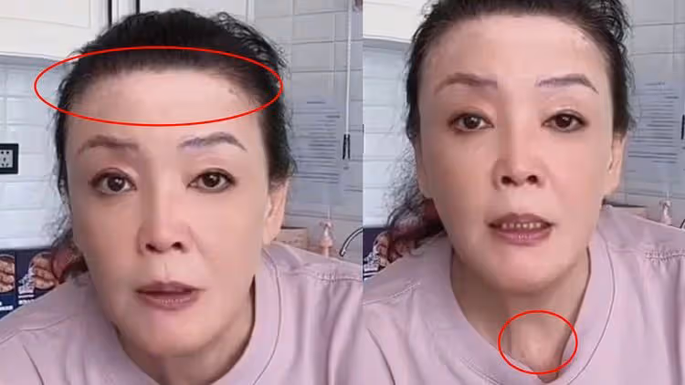 汪小菲知道嗎？66歲張蘭罹「白癜風」　額頭脖子冒白斑