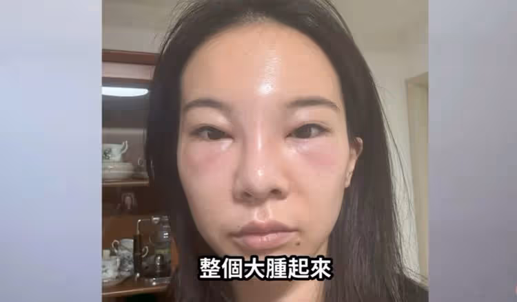網美奎丁毀容腫成豬頭照曝光！用肋骨重建鼻子「差一點就掛了」