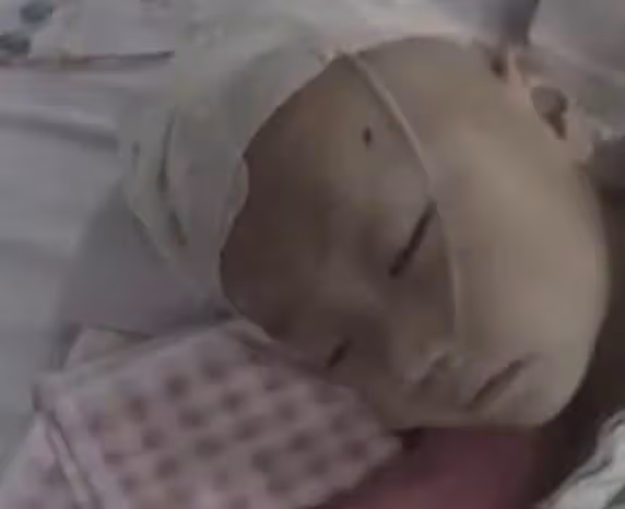 2015年1歲男童鼻涕不止,醫生檢查後發現,腦部竟插入7厘米筷子