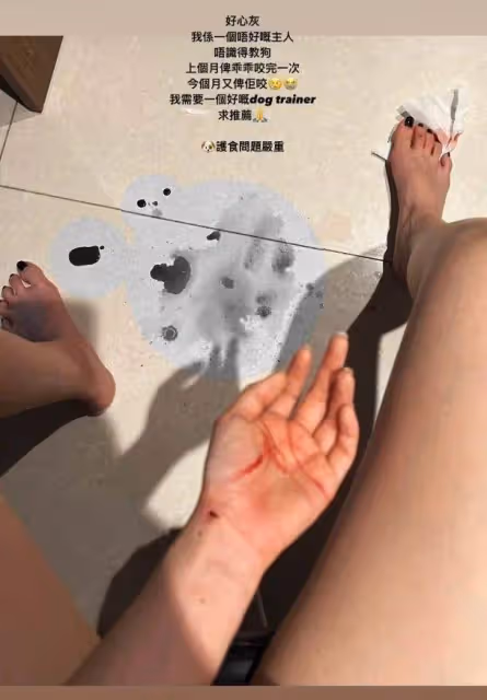 TVB小花被「同居者」咬傷就醫!爆對方被閹:是不是恨我