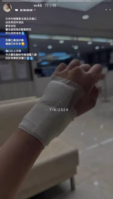 TVB小花被「同居者」咬傷就醫!爆對方被閹:是不是恨我