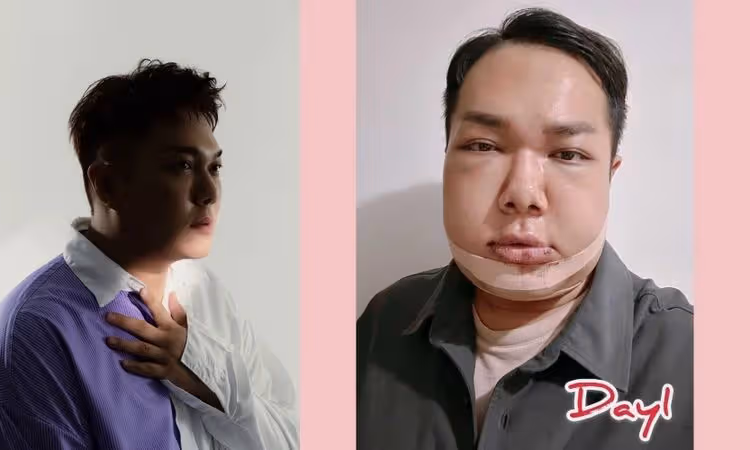 知名YouTuber正顎手術「豬頭腫臉」痛不欲生 爆哭喊：我錯了嗎