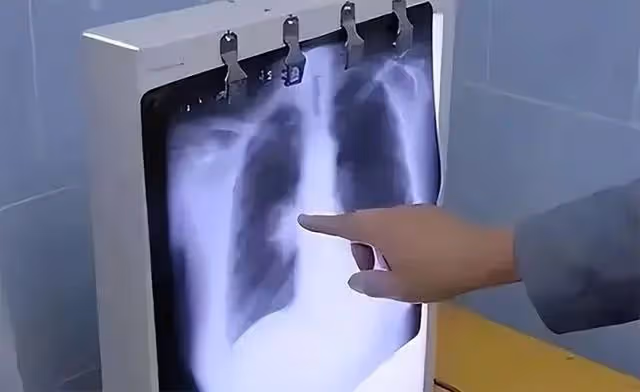 回顧從肺癌晚期到腫瘤消失,人民日報記者抗癌成功,他是怎麼做的