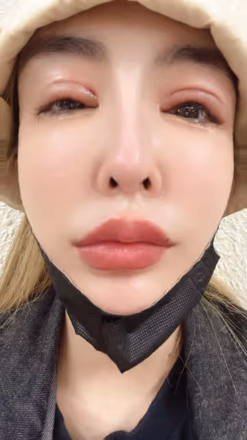 情色教主腫麼了？臉部腫到「睜不開眼」慘照曝光