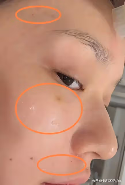 林允又往臉上扎針,打水光+膠原蛋白直喊疼,才28歲就依賴醫美