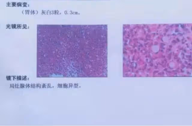 回顧：北大學霸將癌晚期父親騙出國，88天後歸來，結局令人感動