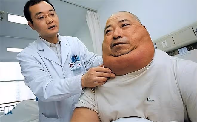 2013年男子20年喝兩萬斤酒,變成「河馬」脖,並自稱:我不算酒神