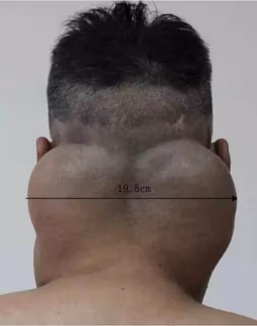 2013年男子20年喝兩萬斤酒,變成「河馬」脖,並自稱:我不算酒神