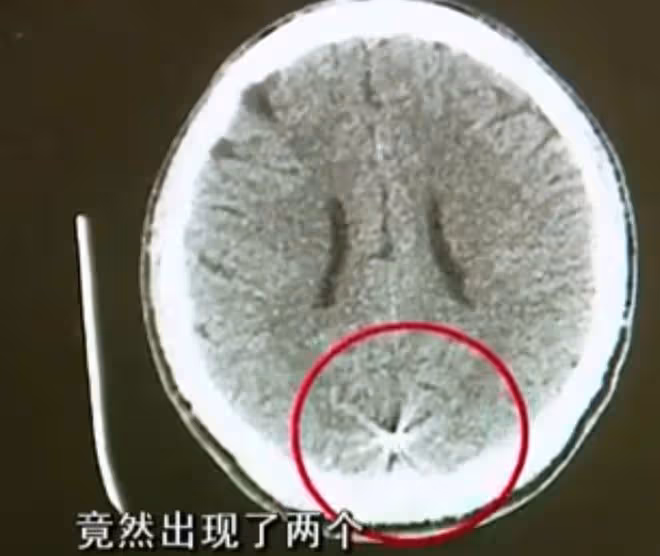 2012年,22歲小伙經常昏倒在地,醫生檢查發現:大腦里有兩顆子彈