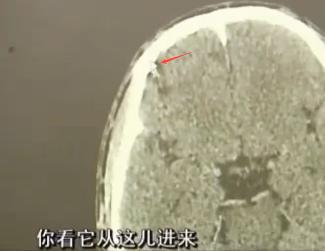 2012年,22歲小伙經常昏倒在地,醫生檢查發現:大腦里有兩顆子彈