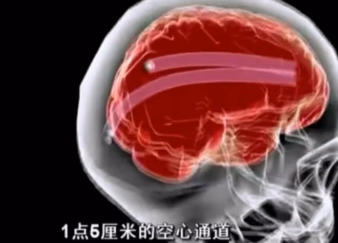 2012年,22歲小伙經常昏倒在地,醫生檢查發現:大腦里有兩顆子彈