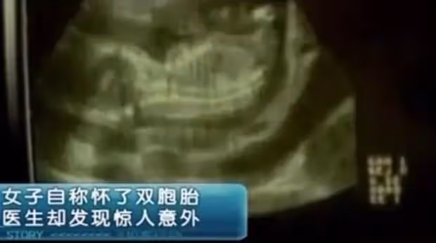 女子剛出月子,竟發現「肚裡還有一子」,醫生:當時明明只有一個
