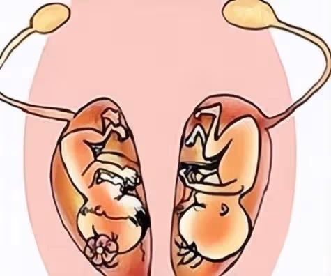 女子剛出月子,竟發現「肚裡還有一子」,醫生:當時明明只有一個