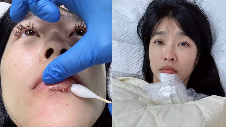 小嫻2天前起床撞傷嘴唇門牙 　「未來3個月要戴維持器，講話會漏風」