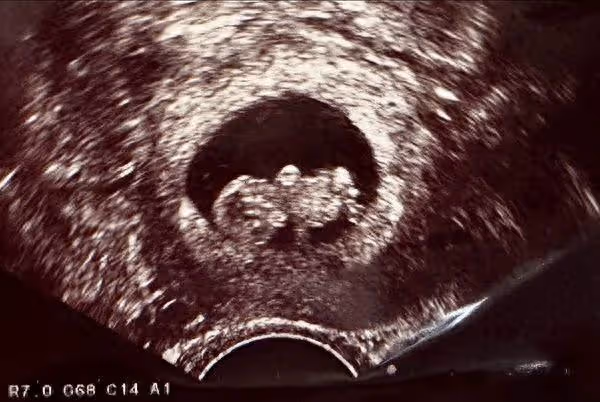快訊/41歲李佳穎試管成功「懷孕5個月」了! 喜曬超音波:年底見