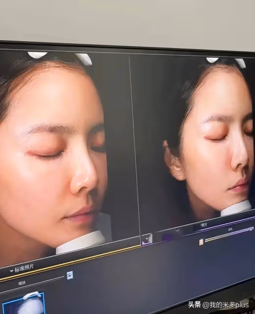 杜淳老婆去醫院做美容,王燦大方曬雷射美白過程,自誇皮膚好到爆