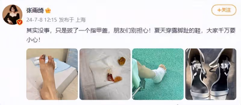 隔著螢幕都覺得疼!張雨綺拍戲腳指頭受傷被拔指甲