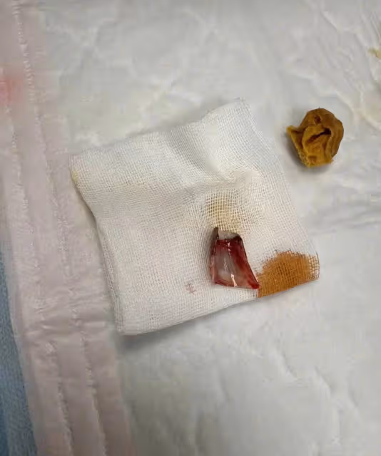 隔著螢幕都覺得疼!張雨綺拍戲腳指頭受傷被拔指甲