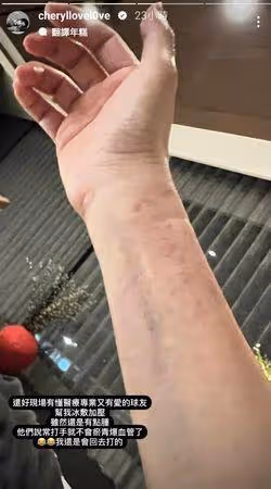 楊謹華「靜脈血管爆掉」傷照曝!淚眼:還有點腫 低調現蹤球場全被拍