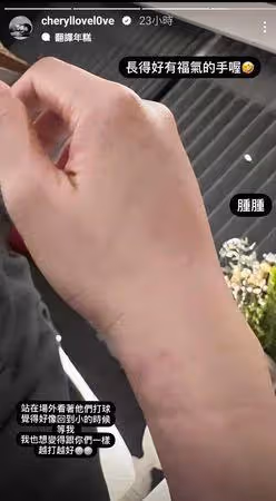楊謹華「靜脈血管爆掉」傷照曝!淚眼:還有點腫 低調現蹤球場全被拍