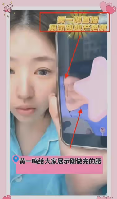黃一鳴給網友看剖腹產疤痕，還問網友腰好不好看，網友：太難堪！