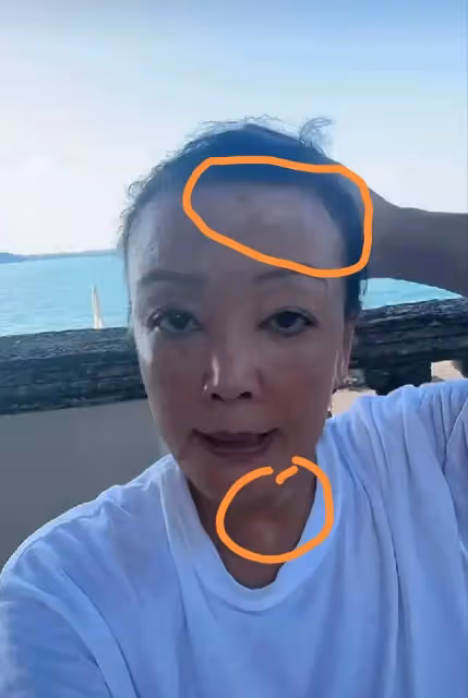 張蘭直播臉上白癜風太明顯,眉頭脖子色差太明顯,網友吐槽太拼了