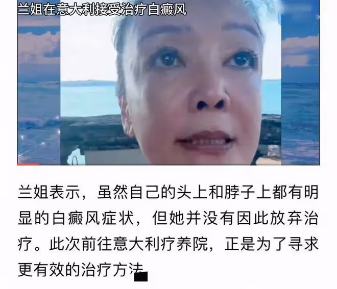 曝張蘭患白癜風!不想拖累兒子跑國外治病,脖子胸前嚴重症狀蔓延