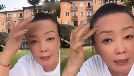 曝張蘭患白癜風!不想連累兒子跑國外治病,脖子胸前嚴重症狀蔓延